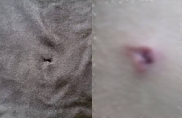 지난달 경북 예천의 한 중학교에서 양궁부 선배가 쏜 화살에 맞아 상처를 입은 학폭 사건이 발생했다. /사진=KBS 캡처