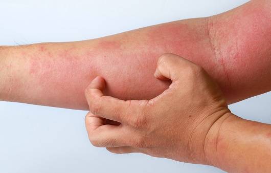 콜린성 두드러기의 원인과 치료, 그리고 대처법