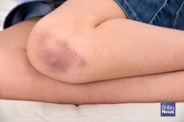 아직 말을 하지 못하는 아이의 몸에 생긴 멍. 서로 간의 오해를 풀기 위해서 어떻게 해야할까? ⓒ베이비뉴스