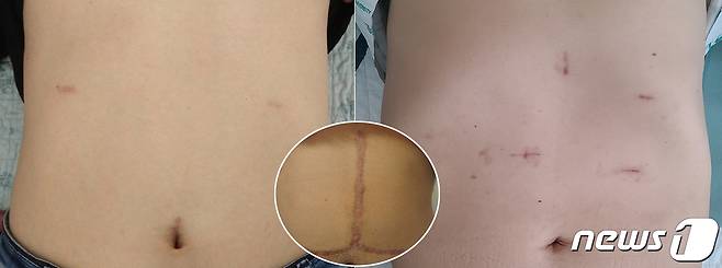 복강경으로 간이식 수술을 한 기증자(왼쪽)과 수혜자(오른쪽)의 상처. 원 안은 기존 개복으로 간이식 수술을 한 복부 상처. (제공 서울대병원)© 뉴스1