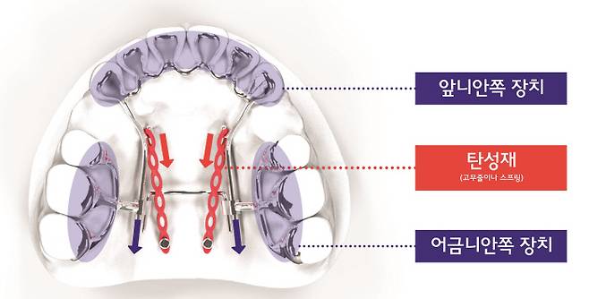 킬본 치아교정장치 부착 가상도.&nbsp;메디센 제공