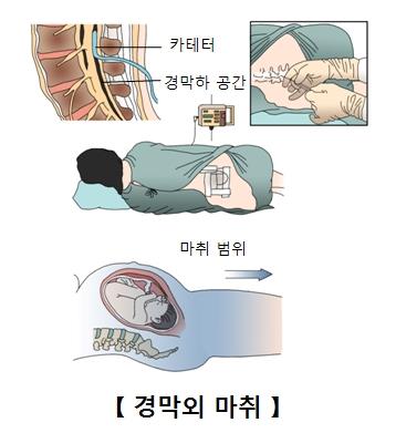 경막외 마취 [출처: 서울아산병원]