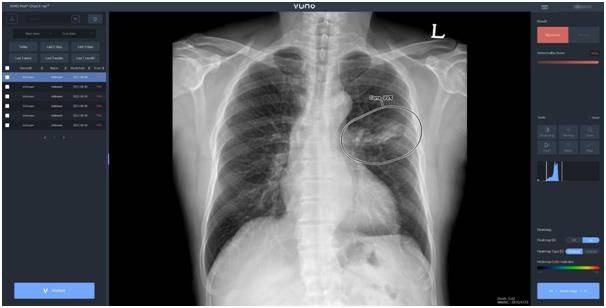 뷰노메드 체스트 엑스레이 스크린샷./연합뉴스
