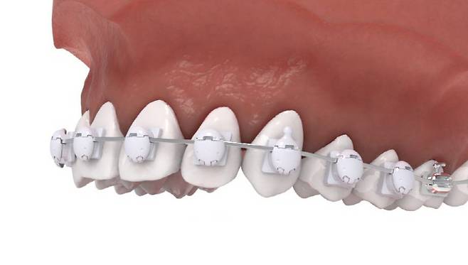 국내 원천기술로 개발되어 특허를 받은 `펄레이스` 치아교정장치 부착 예시. [사진 제공 = 메디센]