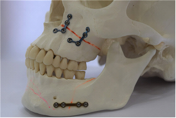 금속판과 금속나사를 이용하여 골절단 부위를 고정한 예시 모습.