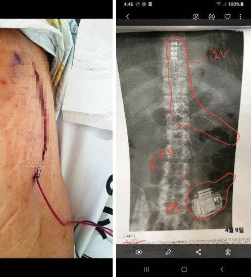 신은총 하사는 극심한 통증을 줄이기 위해 통증 조절 장치를 몸 속에 넣는 큰 수술을 지난 2019년 9월부터 지난해 4월까지 5차례에 걸쳐 받았다. 사진 왼쪽은 장치를 넣은 부위, 오른쪽은 X-레이 촬영 사진이다. 신은총 예비역 하사