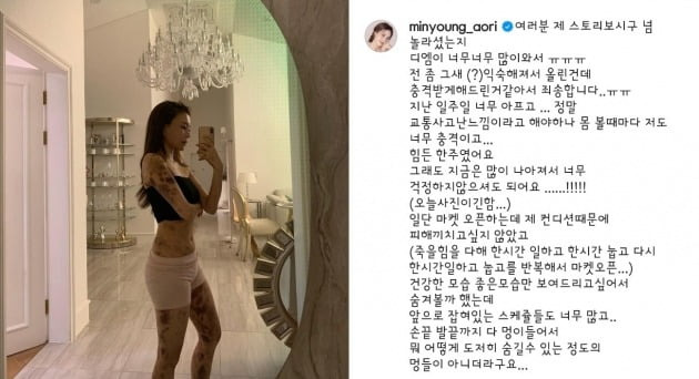 건강주사를 맞은 후 온몸에 피명이 든 모습을 공개했던 모델 출신 유튜버 아옳이(본명 김민영)가 대학병원에서 검진을 받았다. /사진=아옳이 인스타그램