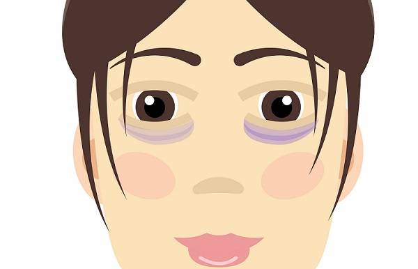 환절기에 유독 다크서클이 심해진다면 알레르기 비염 때문일 수 있다./사진=게티이미지뱅크