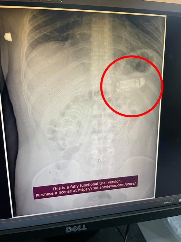 몇 달 전 코소보에서도 이와 비슷한 사건이 있었다. 9월 뉴스위크 보도에 따르면 코소보 프리스타에 사는 33세 남성 역시 휴대폰을 통째로 삼켰다가 복통을 느껴 병원을 찾았다.