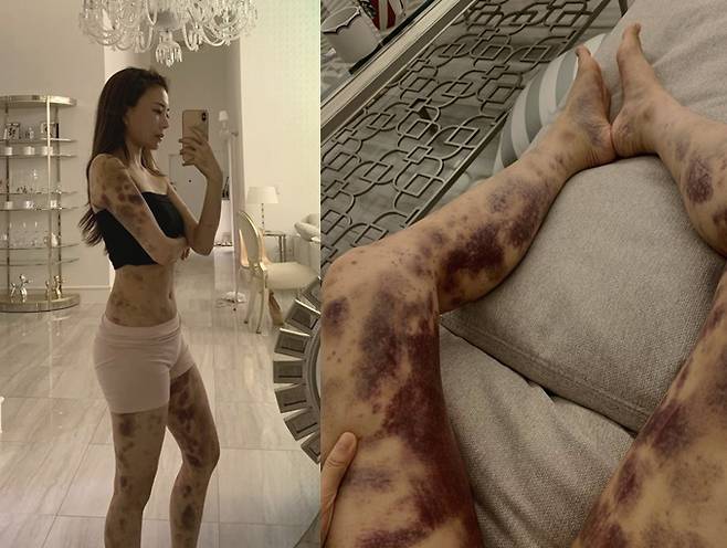 인플루언서 김민영씨가 지난 9일 자신의 인스타그램에 올린 부작용 상황