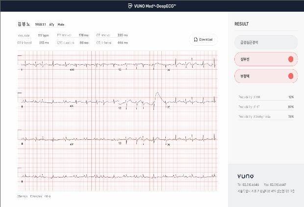 심전도 분석 소프트웨어 구동 화면 예시 [식품의약품안전처 제공. 재판매 및 DB 금지]