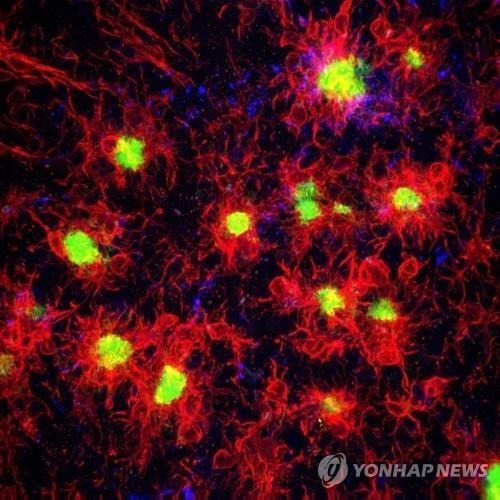 아밀로이드 베타 플라크(녹색)를 공격하는 소교세포(적색)  [미 어바인 캘리포니아대 제공 / 재판매 및 DB 금지]