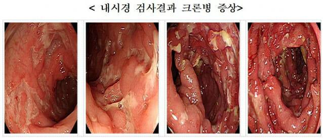 내시경 검사결과 크론병 증상2(사진=국민건강보험공단)