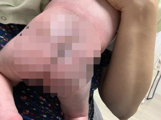 지난 7월 전북 전주의 한 산부인과에서 태어난 여아가 병원 측이 체온 유지를 위해 등 쪽에 놓은 핫팩 때문에 생후 6시간 만에 엉덩이와 허리 부위에 3도 화상을 입었다. 사진 피해자 부모