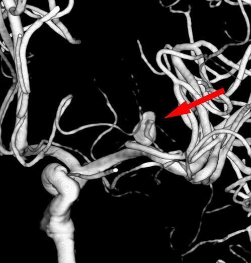 자기공명 혈관 영상(MRA)으로 촬영한 뇌동맥류 모습. 한국일보 자료사잔