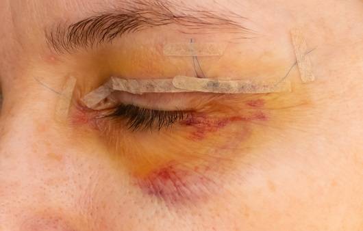 절개 라인에 생긴 흉터