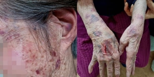 주간 노인보호센터에서 80대 치매 할머니가 폭행당했다는 주장이 제기돼 경찰이 수사에 나섰다. /사진=뉴스1