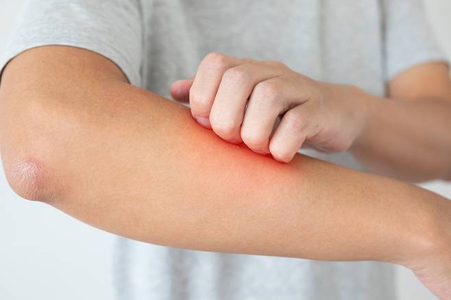 영국의 오미크론 감염자들에게서 특이한 피부 증상이 발견되고 있다는 조사 결과가 나왔다. 게티이미지뱅크