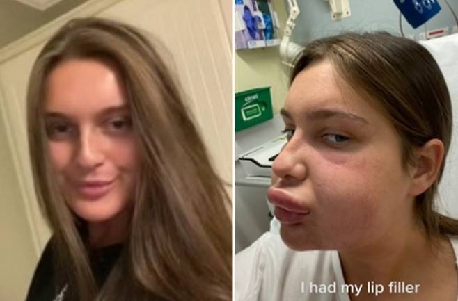 입술 필러 주사 부작용으로 입술이 오리입처럼 부풀어 오른 여성의 모습(오른쪽). [틱톡 캡처]