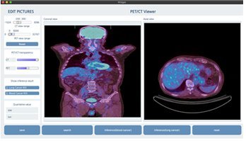 ▲ PET-CT 영상 기반 폐암 및 혈액암 AI 판독 보조 소프트웨어(사진 제공: 에이아이더뉴트리진)