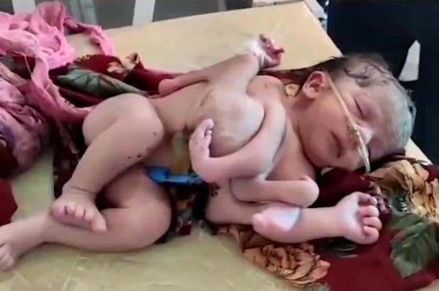 지난 17일 인도에서 팔과 다리가 각각 4개인 아기가 태어났다. /트위터 캡처