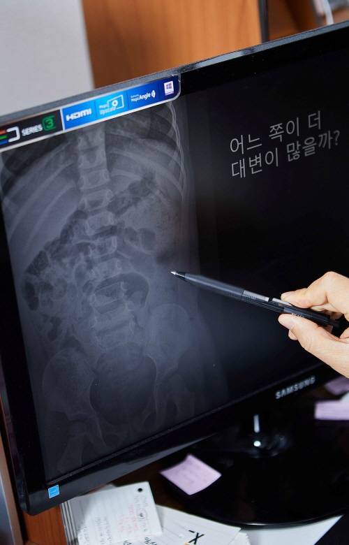 사진=소아변비로 병원을 찾은 아이의 엑스레이 /신지호 헬스조선 기자
