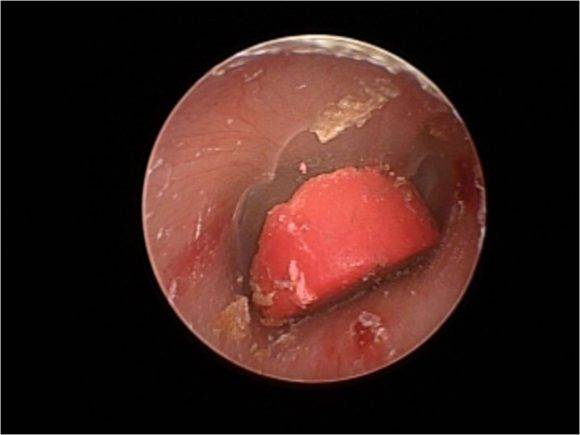 우측 외이도에 이물질이 들어간 사례 [사진=한림대동탄성심병원 제공]