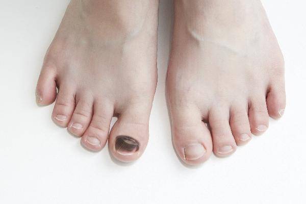 이유 없이 발톱에 생긴 멍이 2주 이상 사라지지 않는다면 흑색종을 의심해봐야 한다./사진=헬스조선 DB