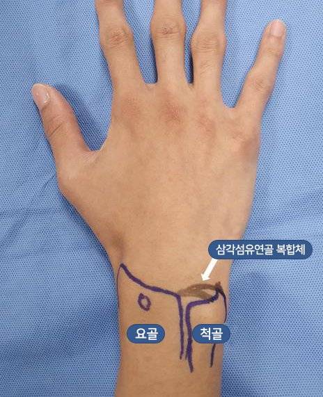 손목관절과 손목인대(삼각섬유연골복합체)./사진=대한스포츠의학회