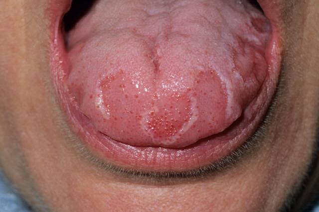 혓바늘은 대부분 과로나 스트레스로 침 분비가 줄어 생긴다