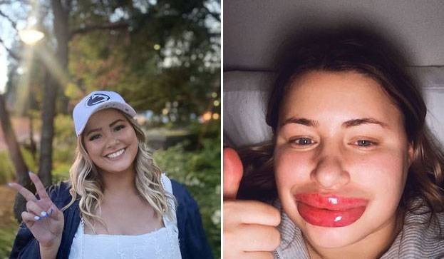 “필러 알레르기 조심하세요”…입술이 8배로 커진 美 여성의 사연