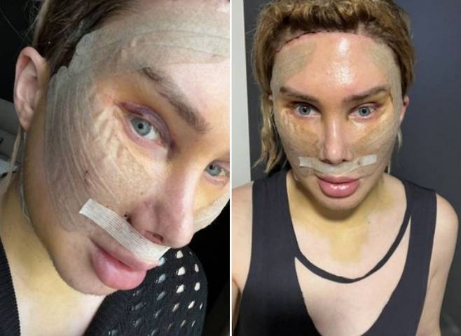 한국인 여성이 되고 싶어 지난 8일 터키 이스탄불에서 성형수술을 받은 후 올리 런던의 모습. [올리 런던 SNS 캡처]