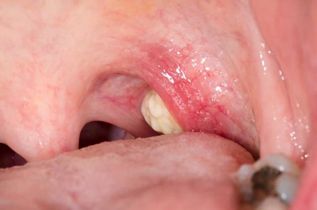 편도결석은 고약한 입 냄새를 유발한다./사진=클립아트코리아