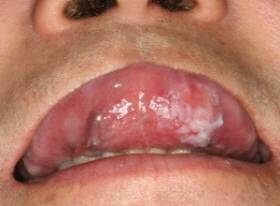 구강 점막에 적색이나 백색 반점<사진>이 생기면 구강암을 의심해볼 필요가 있다./사진=서울대치과병원 제공