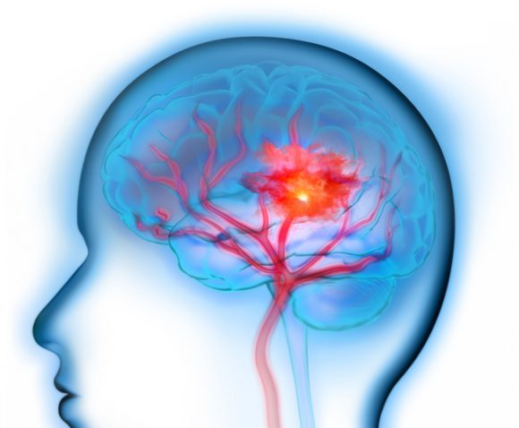 뇌졸중은 뇌로 가는 혈류가 막히거나 뇌 혈관이 파열되는 것을 의미한다. [사진=게티이미지뱅크]