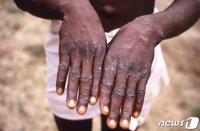 미국 질병통제예방센터가 제공한 콩고민주공화국에서 1997년 촬영한 원숭이두창 감염자의 손 사진 © AFP=뉴스1 © News1 정윤미 기자