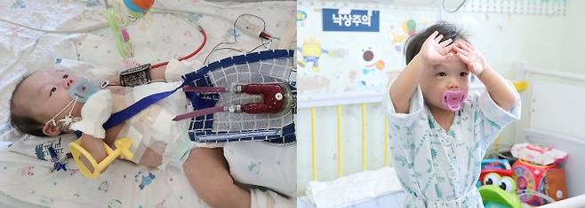 선척적 심장질환을 앓는 권순후 아기가 체외형 심실보조장치를 삽입받고(왼쪽) 400일간 유지한 끝에 심장 기능을 회복하고 건강한 모습으로 퇴원을 앞두고 있다. 서울대병원 제공