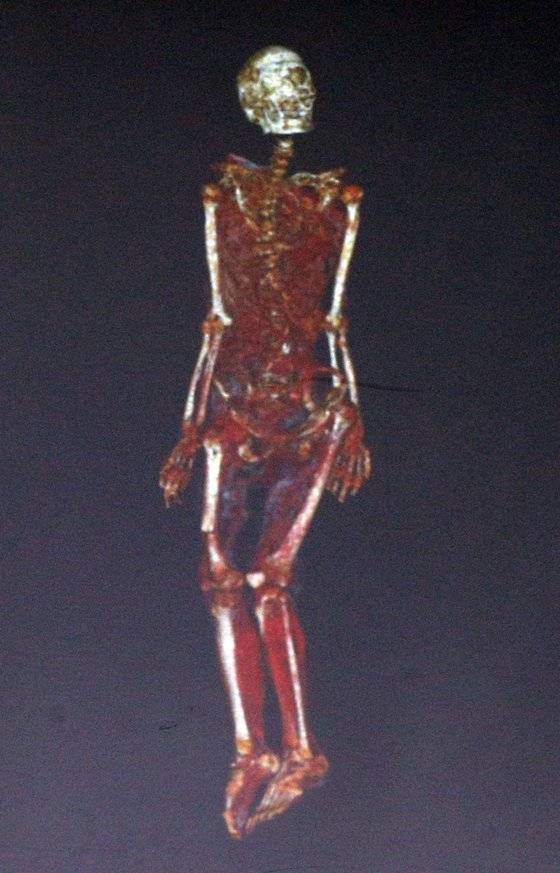 2014년 7월 25일 오전 서울 양천구 국립과학수사연구원 서울분원에서 공개된 유병언 전 세모그룹 회장의 시신 감정 결과 발표. 유 전 회장 추정 엑스선 사진. 중앙포토