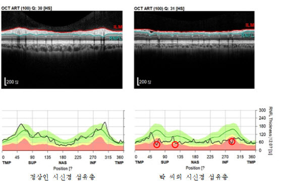 정상인 시신경 섬유층.                                                                                    박 씨의 시신경 섬유층.