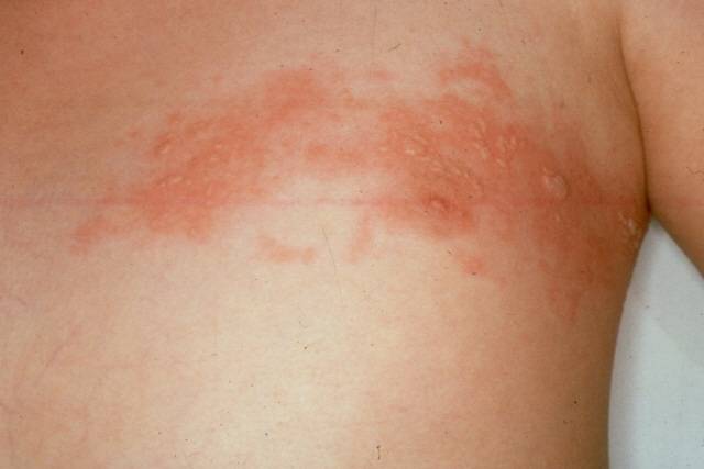 대상포진 /의정부을지대병원 제공