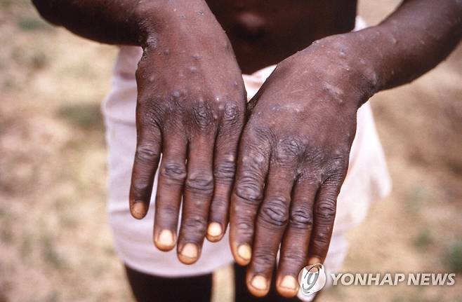 원숭이두창 [AFP 연합뉴스 자료사진. 재판매 및 DB 금지]