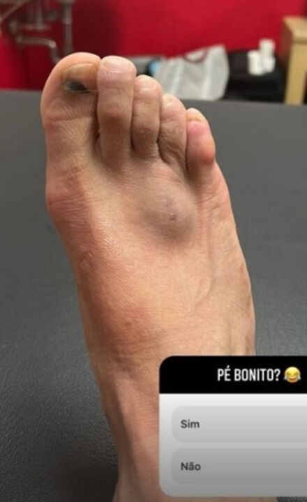 1일 오른발 부상을 입은 네이마르가 자신의 인스타그램 계정에 공개한 발 사진. (사진=네이마르 인스타그램 캡쳐)