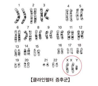 클라인펠터 증후군 [출처: 서울아산병원]