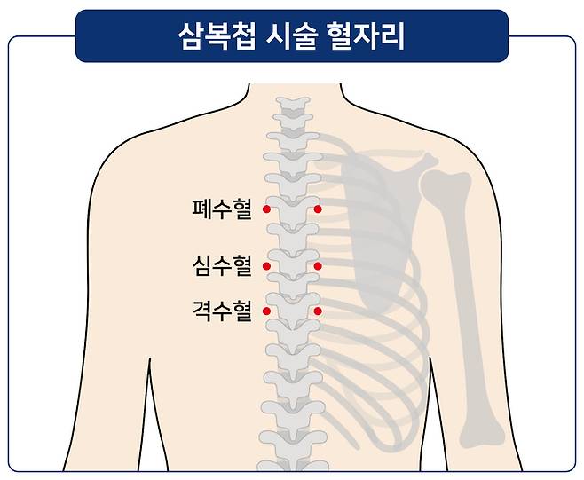 삼복첩 시술 혈자리(사진 : 강동경희대한방병원 제공) *재판매 및 DB 금지