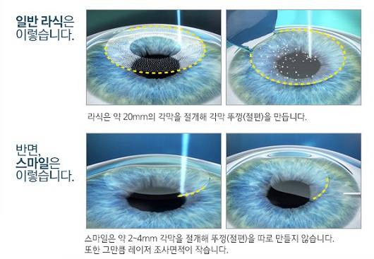 라식 vs 스마일라식ㅣ출처:비앤빛강남밝은세상안과