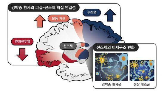 강박증 환자에서 관찰한 대뇌 피질-선조체 회로의 변화.