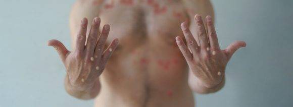 영국에서 원숭이두창 감염자가 1000명을 넘어섰다. [사진=게티이미지뱅크]