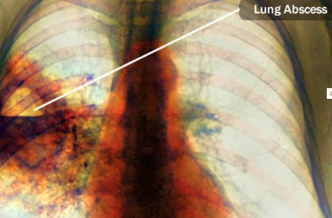 폐렴 합병증에 의한 폐농양. [사진 출처 = 웹엠디]