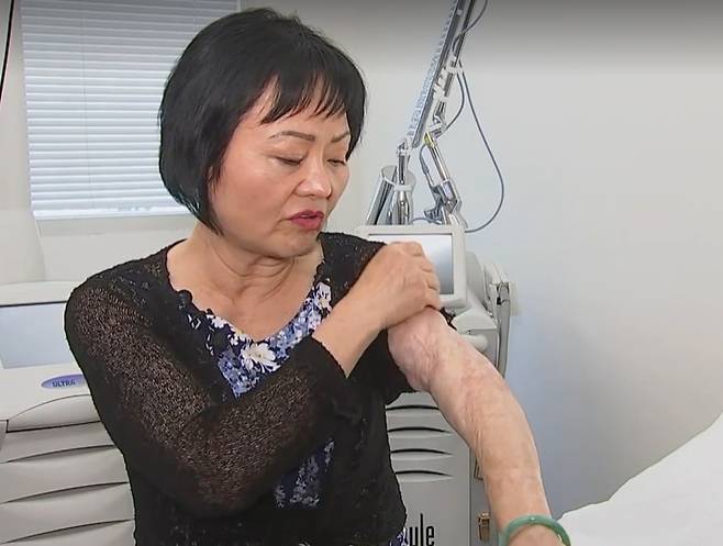 네이팜탄으로 화상을 입은 판티 킴 푹이 지난달 28일(현지시각) 미국 마이애미 한 피부과에서 화상 치료를 마친 모습 /NBC