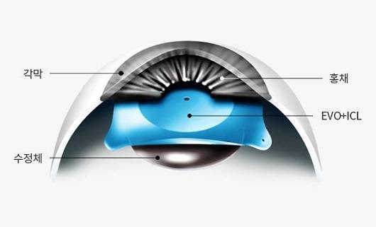 렌즈삽입술ㅣ출처:비앤빛강남밝은세상안과